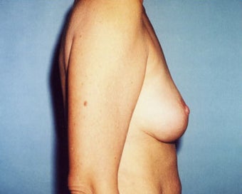 Breast Lift Increases Areolar Height for 45 Year Old Woman