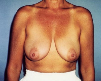 Breast Lift Increases Areolar Height for 45 Year Old Woman