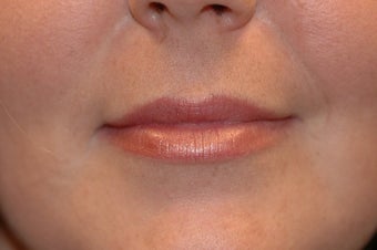 Juvederm in Upper Lip