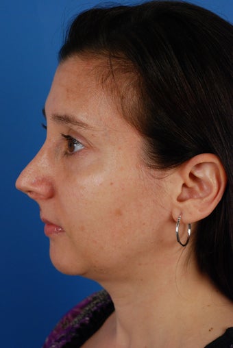 Revision rhinoplasty patient after 2 prior rhinoplasties
