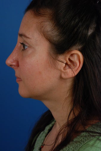 Revision rhinoplasty patient after 2 prior rhinoplasties