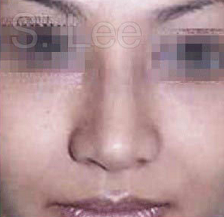 Nose