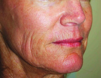 Fractional CO2 Laser