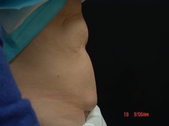 Coolsculpting Abdomen
