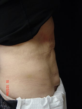 Coolsculpting Abdomen
