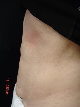 Coolsculpting Abdomen