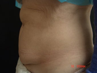 Coolsculpting Abdomen