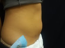Coolsculpting