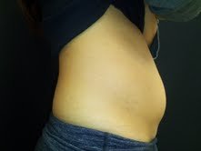 Coolsculpting