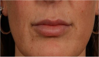 44 year old female with thin lips