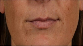 44 year old female with thin lips