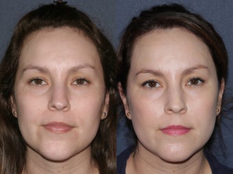Before & After Laser Resurfacing