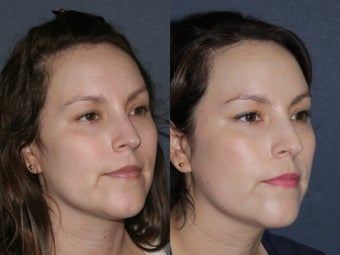 Before & After Laser Resurfacing