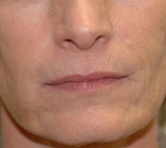 Juvederm