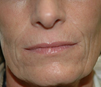 Juvederm