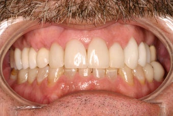 53 Year Old Male gets Smile Makeover