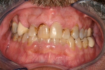 53 Year Old Male gets Smile Makeover