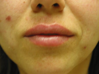 Lip Augmentation 