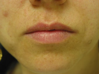 Lip Augmentation 