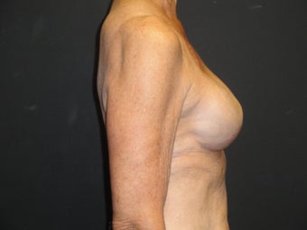 Breast reconstruction - tissue expanders