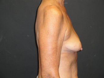 Breast reconstruction - tissue expanders