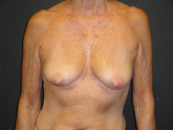 Breast reconstruction - tissue expanders