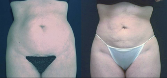 Liposculpture