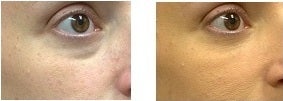 Treatment of Tear Troughs and Under Eye Circles with Restylane Filler