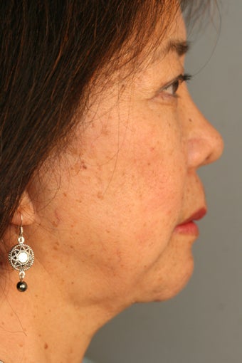 Female Chin Implant 