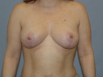 Mastopexy