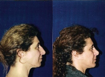 Rhinoplasty and Septoplasty