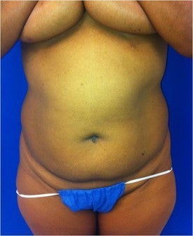 Laser Liposuction