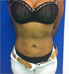 Laser Liposuction