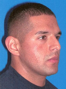 Otoplasty Ear Surgery - Male