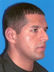 Otoplasty Ear Surgery - Male