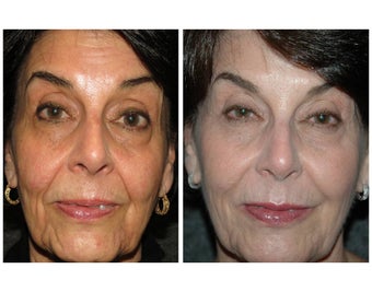 No-downtime "Liquid Lift" for woman in her mid-60's