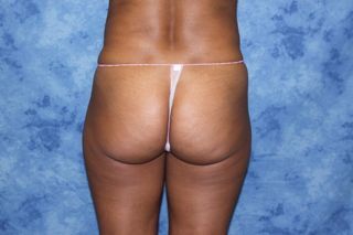 Brazilian Butt Lift and creating curves