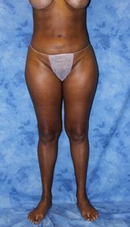 Brazilian Butt Lift and creating curves