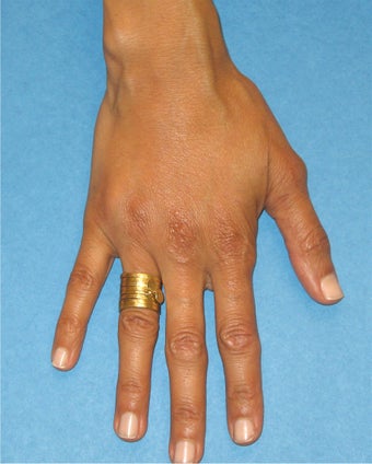 Hand Rejuvenation