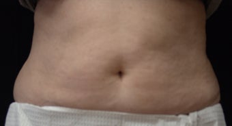 Coolsculpting