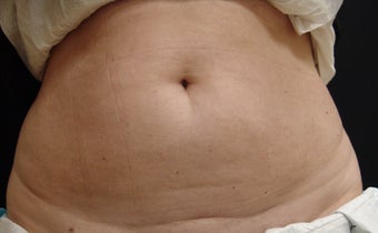 Coolsculpting