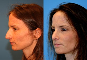 Rhinoplasty also known as nose job