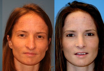 Rhinoplasty also known as nose job