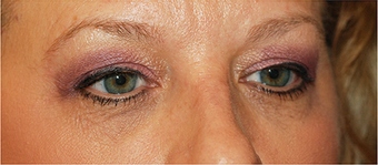 Eye Bag Surgery