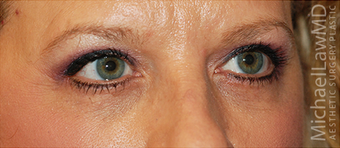 Eye Bag Surgery