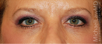 Eye Bag Surgery