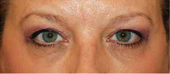 Eye Bag Surgery