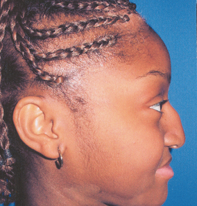 Ethnic Rhinoplasty