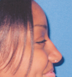 Ethnic Rhinoplasty