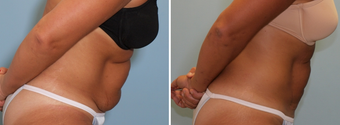 Vaser Lipo Abdomen